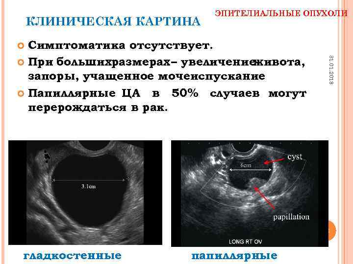 КЛИНИЧЕСКАЯ КАРТИНА ЭПИТЕЛИАЛЬНЫЕ ОПУХОЛИ Симптоматика отсутствует. При большихразмерах – увеличение живота, запоры, учащенное мочеиспускание