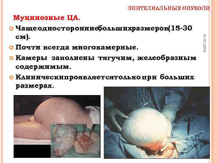 ЭПИТЕЛИАЛЬНЫЕ ОПУХОЛИ 31. 01. 2018 Муцинозные ЦА. Чаще односторонние, большихразмеров(15 -30 см). Почти всегда