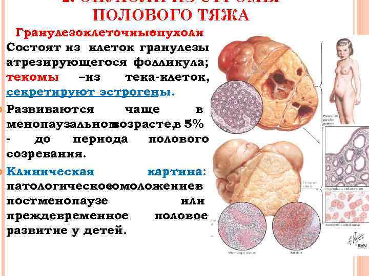 2. ОПУХОЛИ ИЗ СТРОМЫ ПОЛОВОГО ТЯЖА Гранулезоклеточные опухоли. Состоят из клеток гранулезы атрезирующегося фолликула;