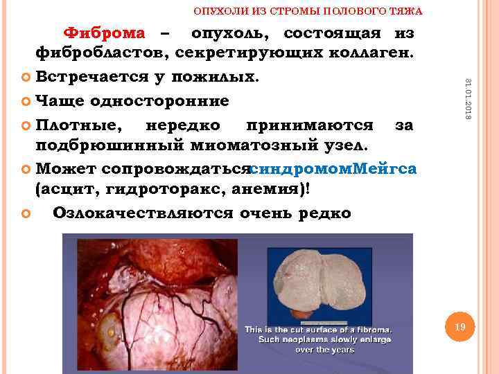 ОПУХОЛИ ИЗ СТРОМЫ ПОЛОВОГО ТЯЖА 31. 01. 2018 Фиброма – опухоль, состоящая из фибробластов,