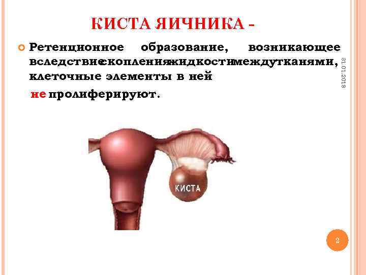 КИСТА ЯИЧНИКА 31. 01. 2018 Ретенционное образование, возникающее вследствие скопления жидкости междутканями, клеточные элементы