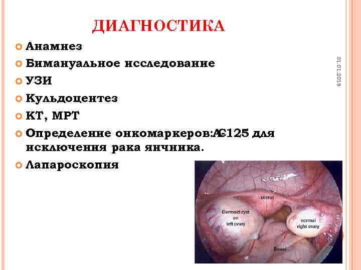 ДИАГНОСТИКА Анамнез Бимануальное исследование УЗИ Кульдоцентез КТ, МРТ Определение онкомаркеров: A-125 для С исключения