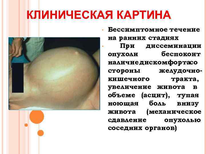 КЛИНИЧЕСКАЯ КАРТИНА • • Бессимптомное течение на ранних стадиях При диссеминации опухоли беспокоит наличие