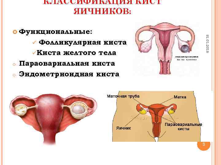 КЛАССИФИКАЦИЯ КИСТ ЯИЧНИКОВ: o o Функциональные: ü Фолликулярная киста üКиста желтого тела Параовариальная киста