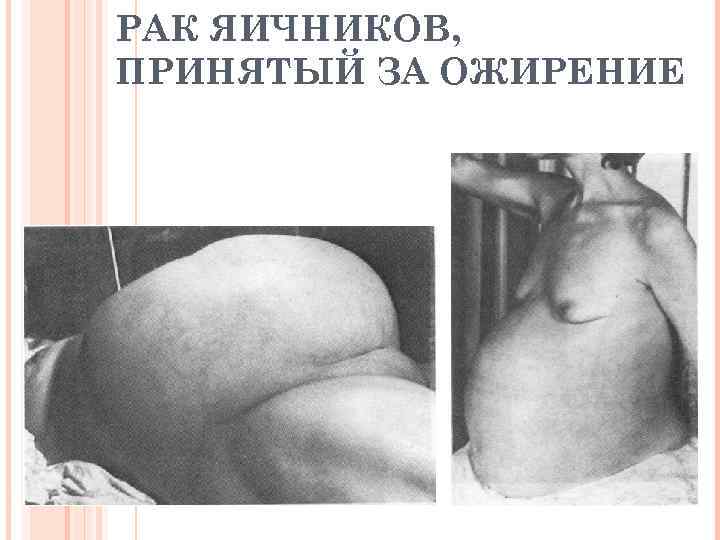 РАК ЯИЧНИКОВ, ПРИНЯТЫЙ ЗА ОЖИРЕНИЕ 
