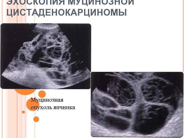 ЭХОСКОПИЯ МУЦИНОЗНОЙ ЦИСТАДЕНОКАРЦИНОМЫ Муцинозная опухоль яичника 