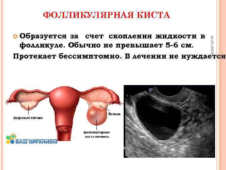 ФОЛЛИКУЛЯРНАЯ КИСТА Образуется за счет скопления жидкости в фолликуле. Обычно не превышает 5 -6