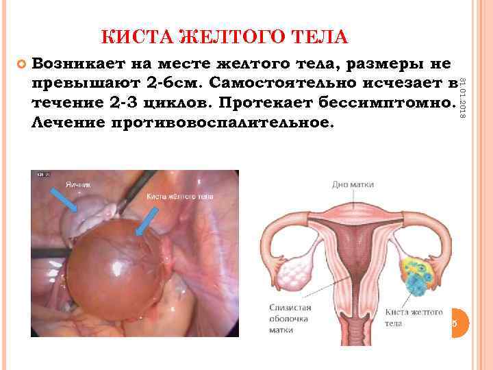 КИСТА ЖЕЛТОГО ТЕЛА 31. 01. 2018 Возникает на месте желтого тела, размеры не превышают