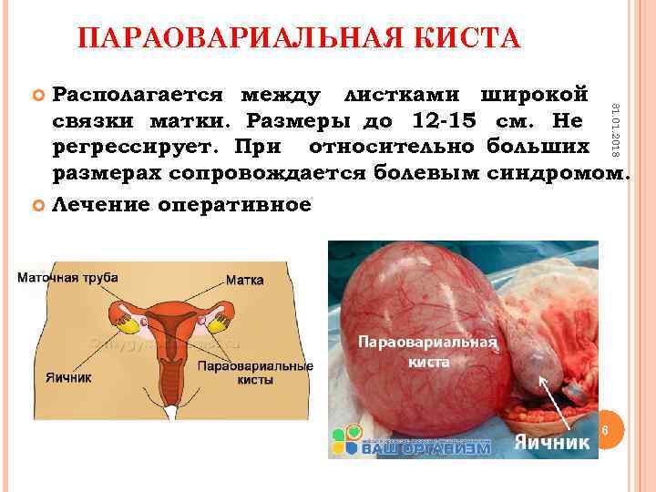 ПАРАОВАРИАЛЬНАЯ КИСТА Располагается между листками широкой связки матки. Размеры до 12 -15 см. Не