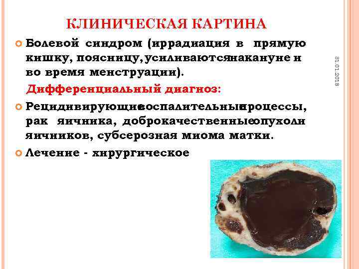 КЛИНИЧЕСКАЯ КАРТИНА Болевой синдром (иррадиация в прямую кишку, поясницу, усиливаютсянакануне и во время менструации).