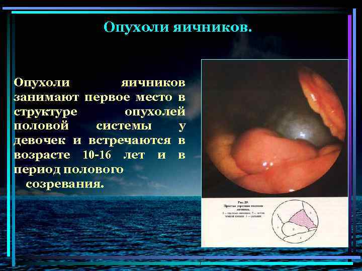 Опухоли яичников. Опухоли яичников занимают первое место в структуре опухолей половой системы у девочек
