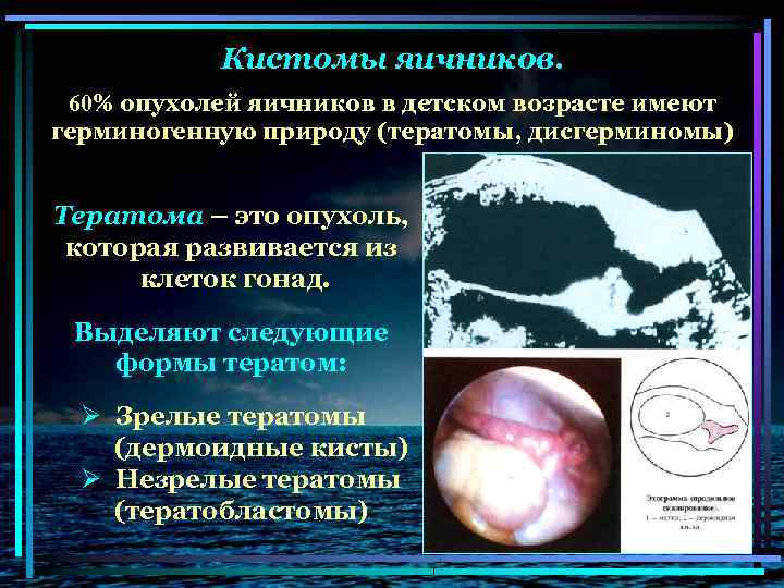Кистомы яичников. 60% опухолей яичников в детском возрасте имеют герминогенную природу (тератомы, дисгерминомы) Тератома