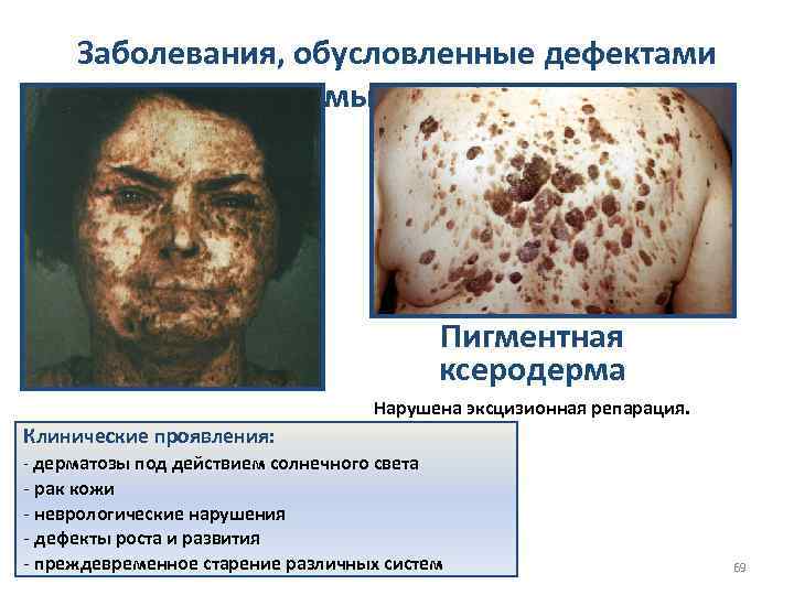 Заболевания, обусловленные дефектами системы репарации Пигментная ксеродерма Нарушена эксцизионная репарация. Клинические проявления: - дерматозы