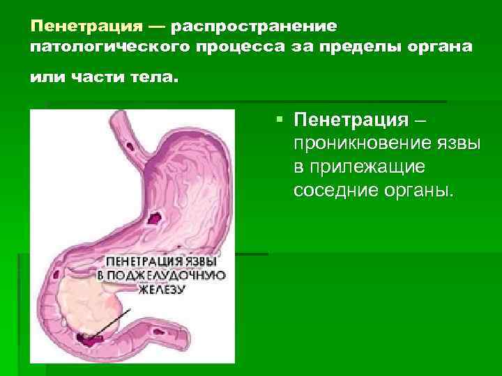 Пенетрация — распространение патологического процесса за пределы органа или части тела. § Пенетрация –