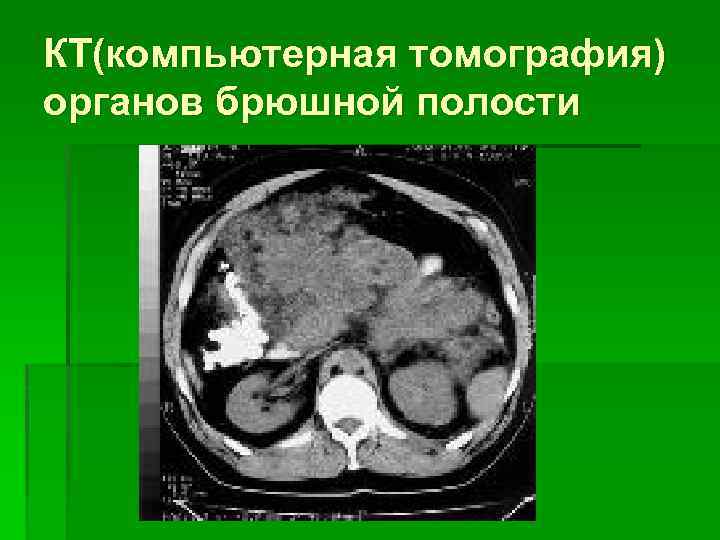 КТ(компьютерная томография) органов брюшной полости 