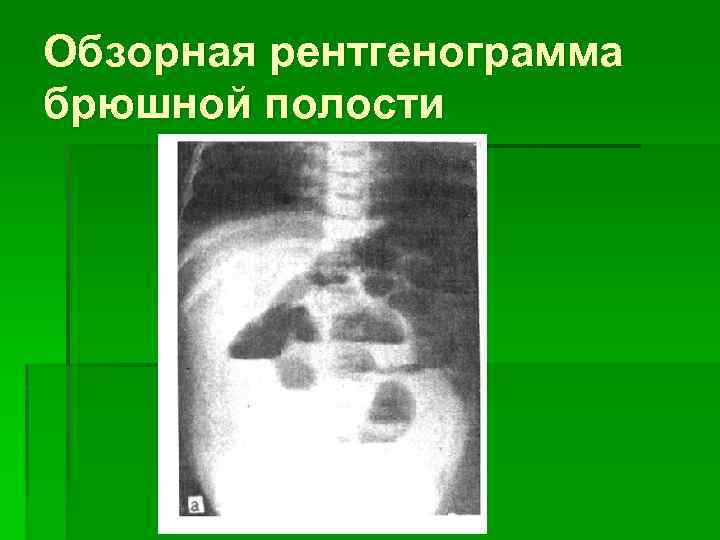 Обзорная рентгенограмма брюшной полости 