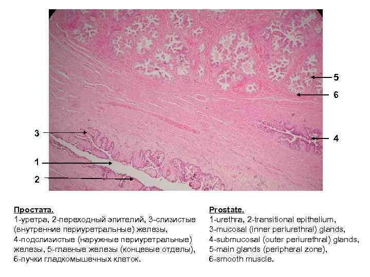 5 6 3 4 1 2 Простата. 1 -уретра, 2 -переходный эпителий, 3 -слизистые
