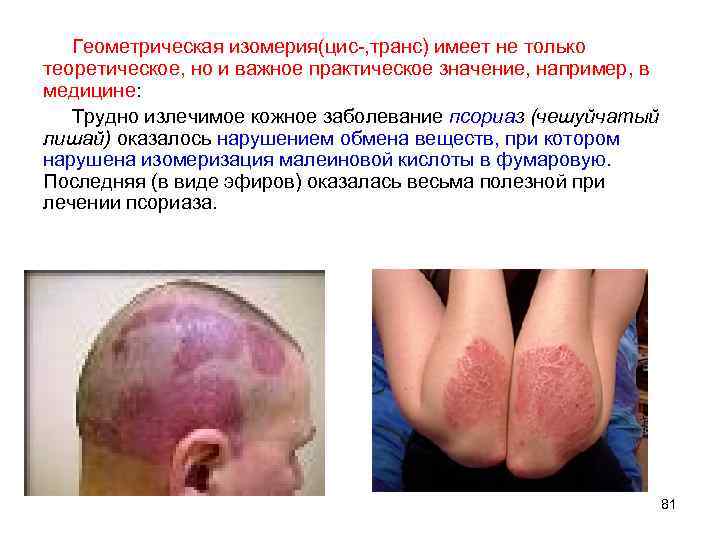 Геометрическая изомерия(цис-, транс) имеет не только теоретическое, но и важное практическое значение, например, в