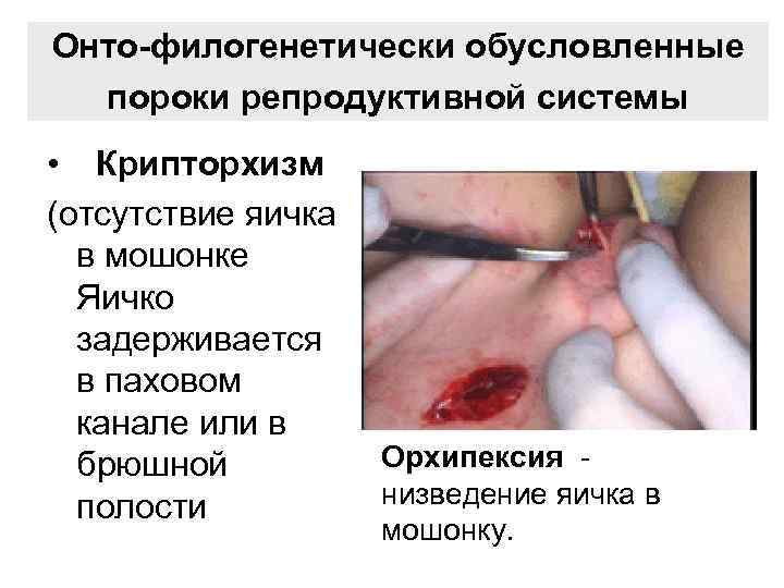 Онто-филогенетически обусловленные пороки репродуктивной системы • Крипторхизм (отсутствие яичка в мошонке Яичко задерживается в