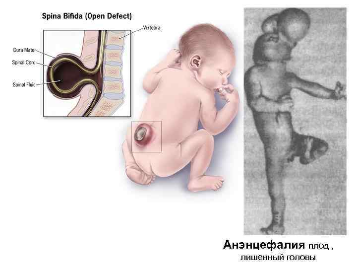 Анэнцефалия плод , лишенный головы 