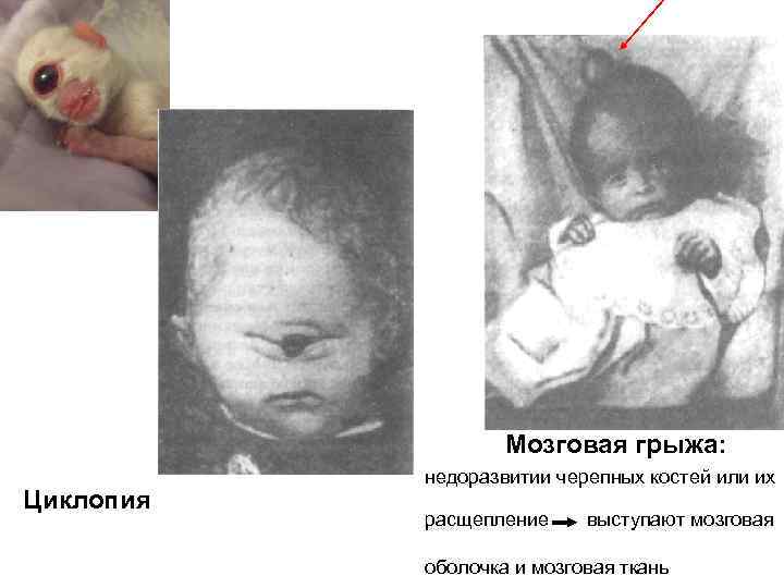 Мозговая грыжа: Циклопия недоразвитии черепных костей или их выступают мозговая оболочка и мозговая ткань