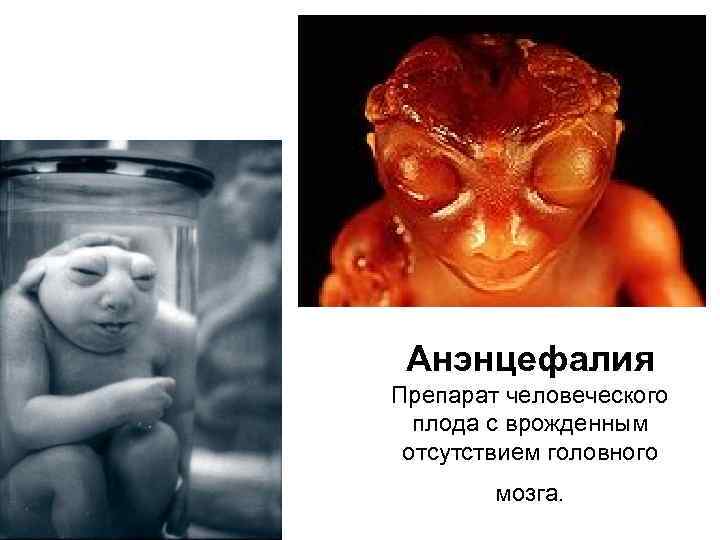 Анэнцефалия Препарат человеческого плода с врожденным отсутствием головного мозга. 