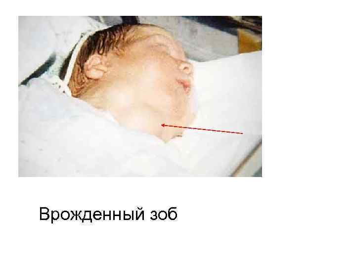 Врожденный зоб 
