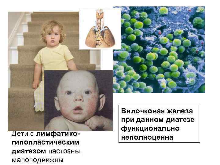 Дети с лимфатикогипопластическим диатезом пастозны, малоподвижны Вилочковая железа при данном диатезе функционально неполноценна 