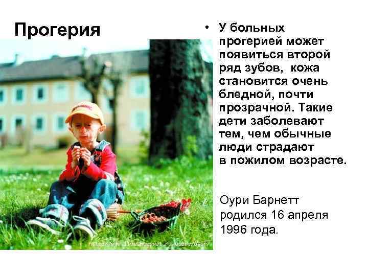 Прогерия • У больных прогерией может появиться второй ряд зубов, кожа становится очень бледной,