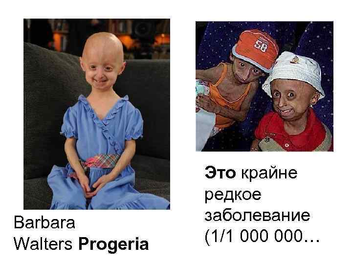 Barbara Walters Progeria Это крайне редкое заболевание (1/1 000… 