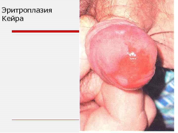 Эритроплазия Кейра 