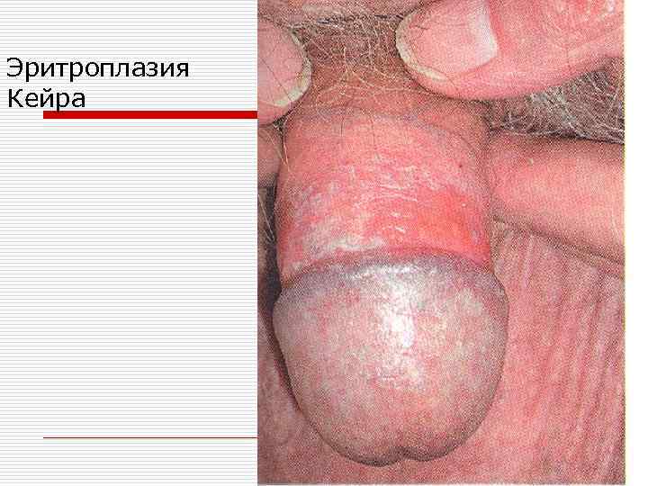 Эритроплазия Кейра 