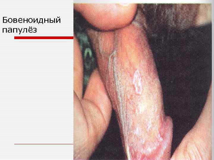 Бовеноидный папулёз 