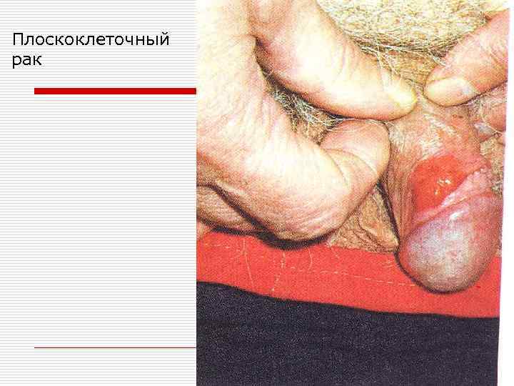 Плоскоклеточный рак 