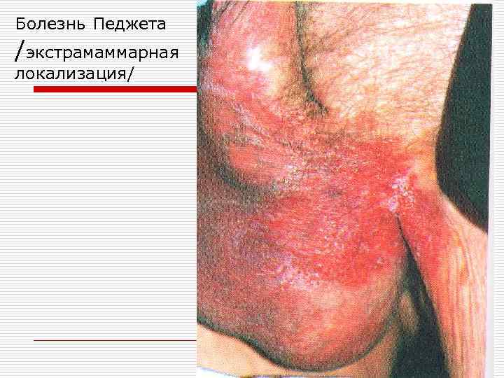 Болезнь Педжета /экстрамаммарная локализация/ 