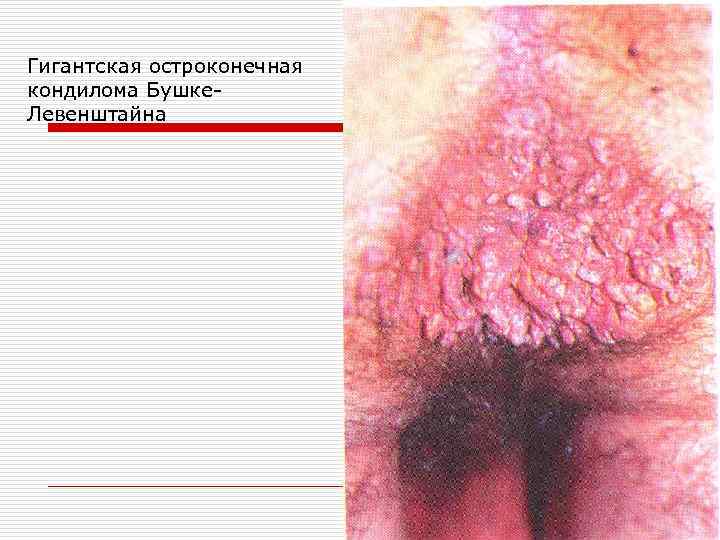 Гигантская остроконечная кондилома Бушке. Левенштайна 