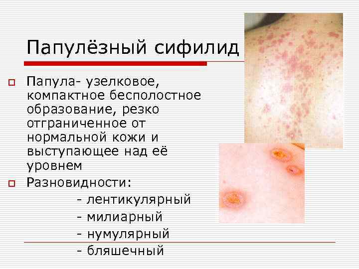 Папулёзный сифилид o o Папула- узелковое, компактное бесполостное образование, резко отграниченное от нормальной кожи