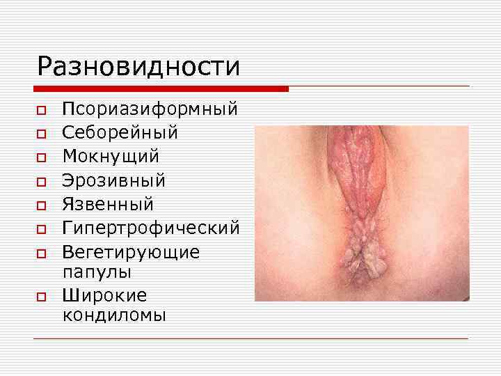 Разновидности o o o o Псориазиформный Себорейный Мокнущий Эрозивный Язвенный Гипертрофический Вегетирующие папулы Широкие