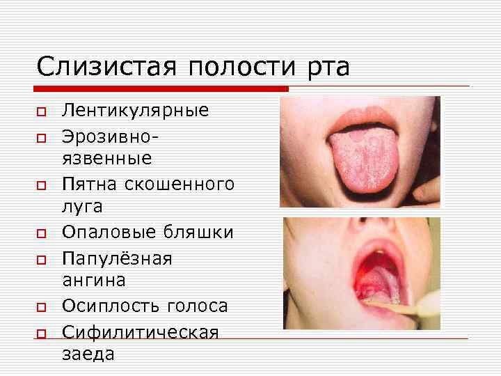 Слизистая полости рта o o o o Лентикулярные Эрозивноязвенные Пятна скошенного луга Опаловые бляшки