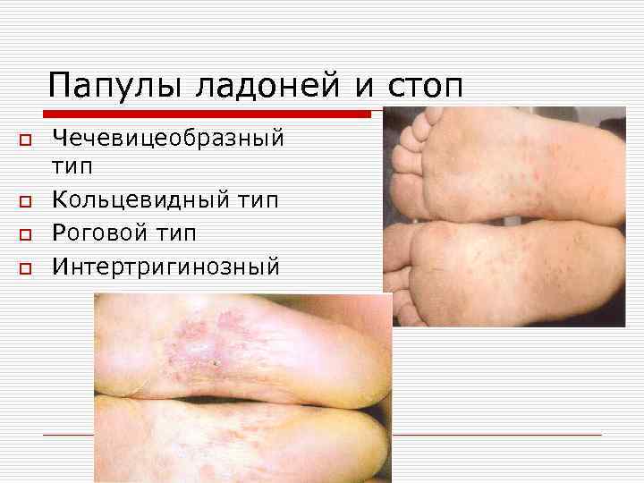 Папулы ладоней и стоп o o Чечевицеобразный тип Кольцевидный тип Роговой тип Интертригинозный 