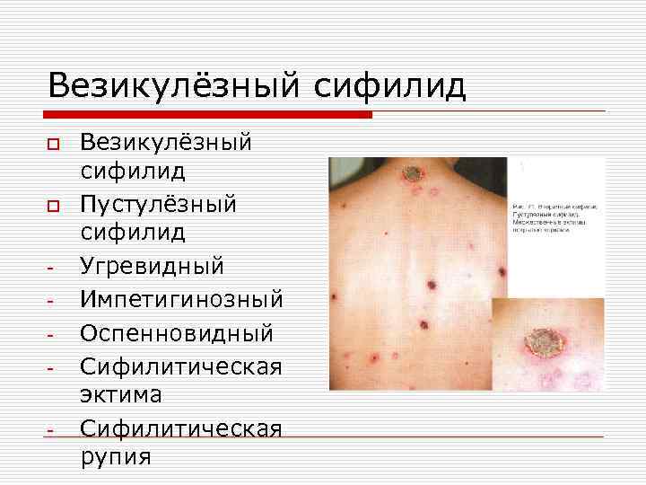 Везикулёзный сифилид o o - - Везикулёзный сифилид Пустулёзный сифилид Угревидный Импетигинозный Оспенновидный Сифилитическая