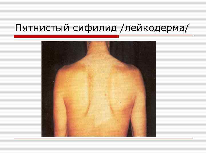 Пятнистый сифилид /лейкодерма/ 