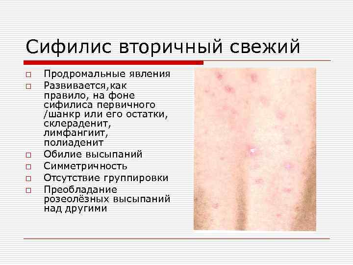 Сифилис вторичный свежий o o o Продромальные явления Развивается, как правило, на фоне сифилиса