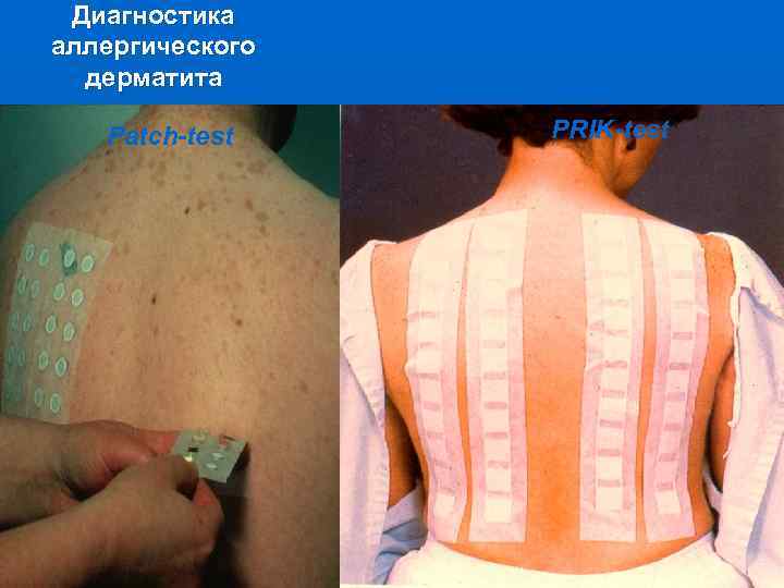 Диагностика аллергического дерматита Patch-test PRIK-test 