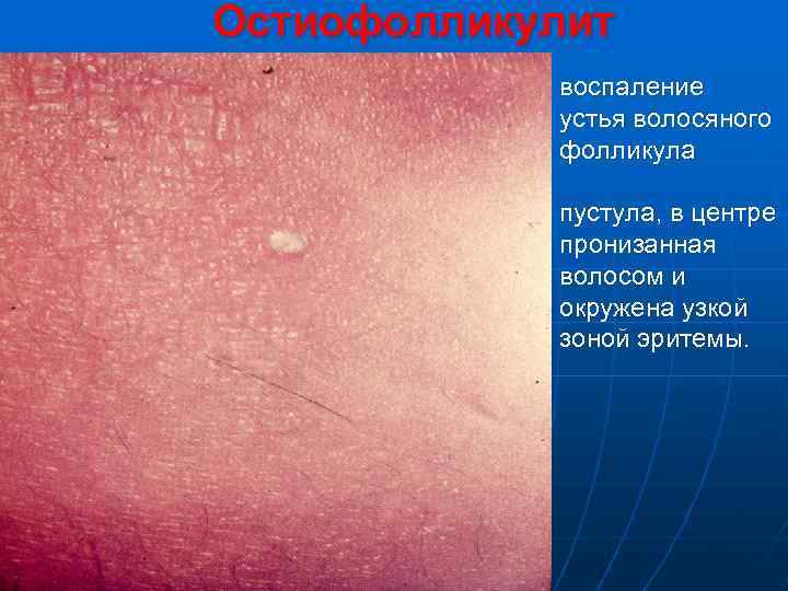 Остиофолликулит воспаление устья волосяного фолликула пустула, в центре пронизанная волосом и окружена узкой зоной