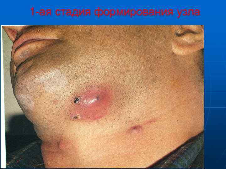 1 -ая стадия формирования узла 