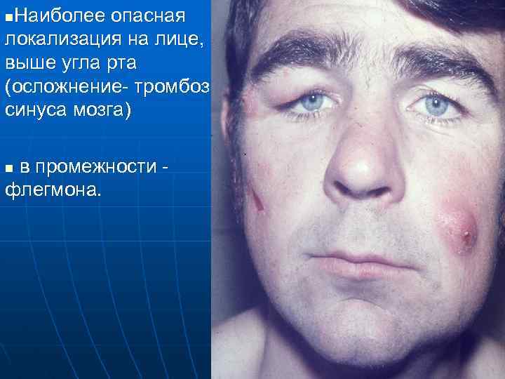 Наиболее опасная локализация на лице, выше угла рта (осложнение- тромбоз синуса мозга) n в