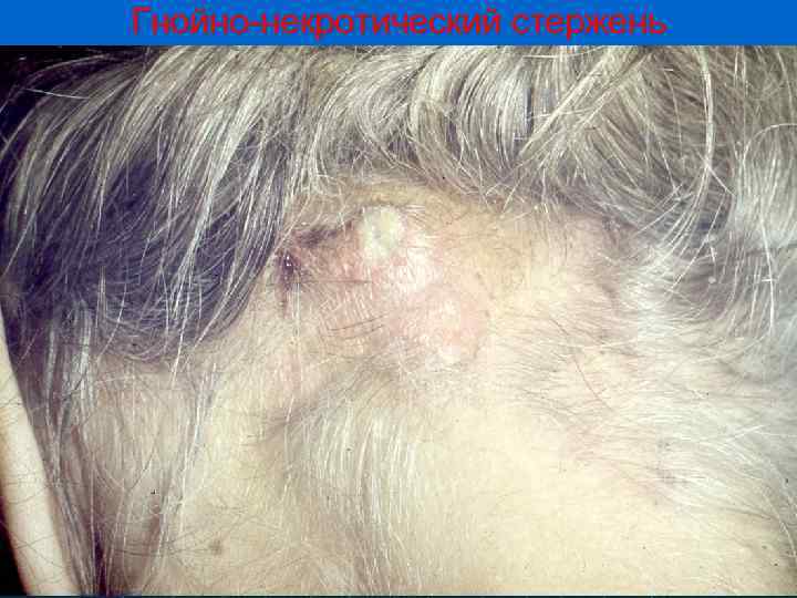 Гнойно-некротический стержень 