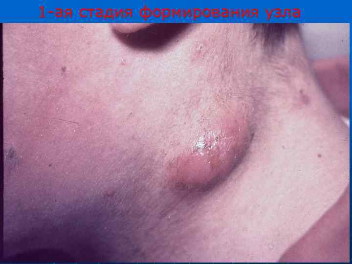1 -ая стадия формирования узла 