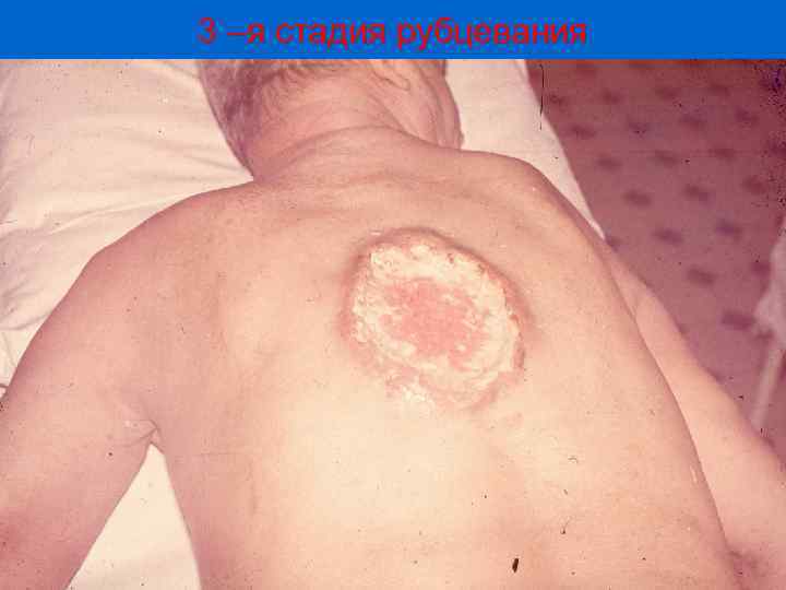 3 –я стадия рубцевания 